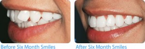 Six Month Smiles Balham - Before and After